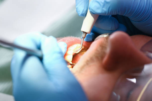 Best Emergency Dental Care for Abscessed Tooth in Somerville, NJ